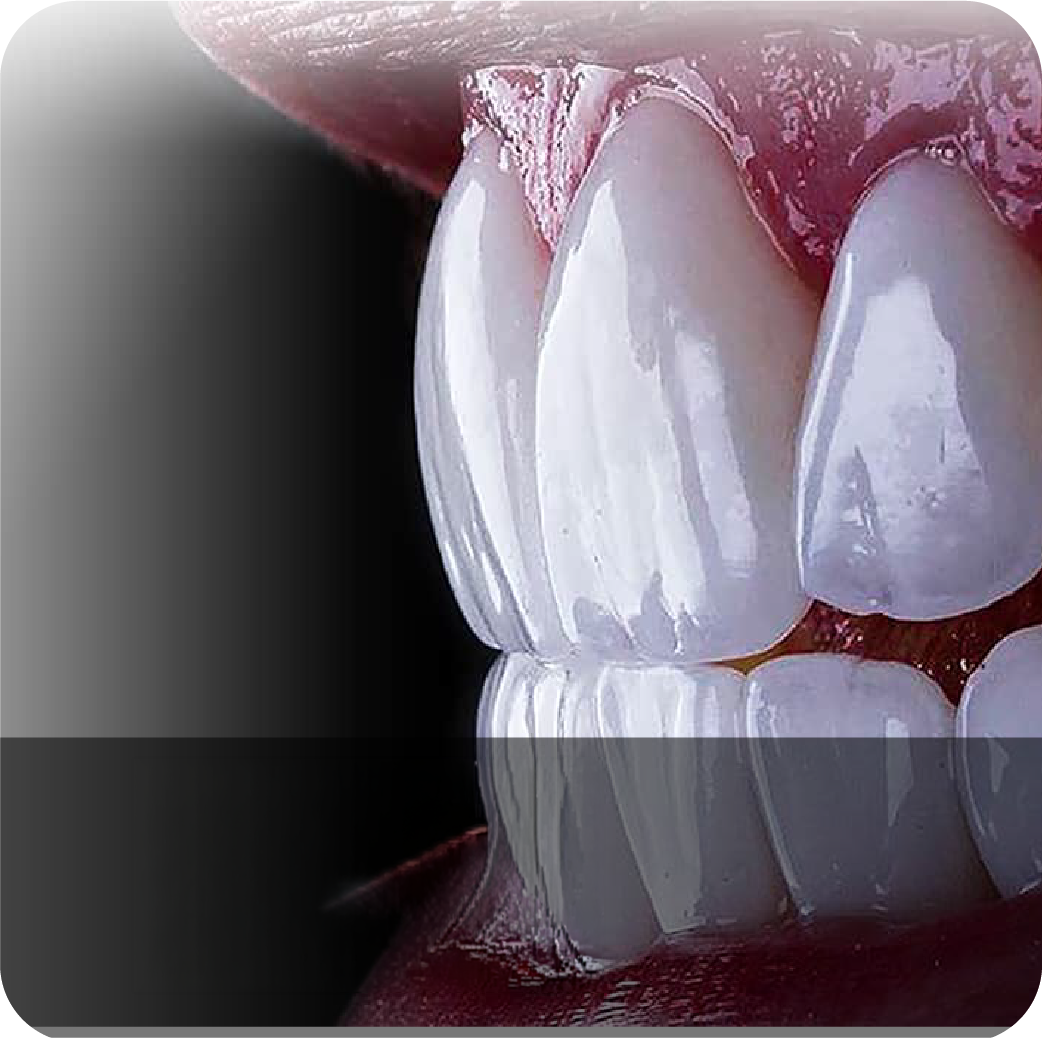 All about veneers – complete guide to transform your smile